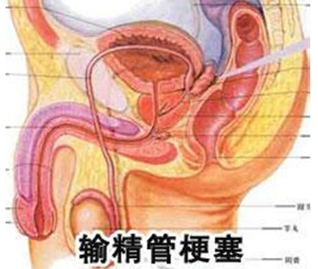 输精管堵塞是什么意思