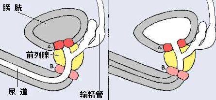 输精管堵塞是什么意思