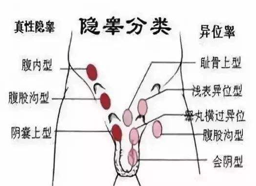 隐睾是什么病