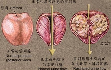 前列腺炎是什么