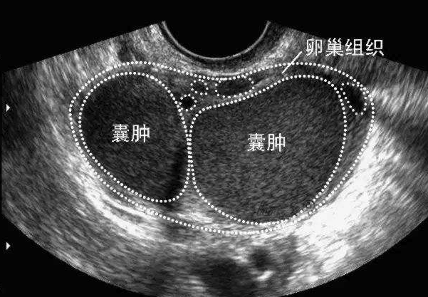 盆腔囊肿是什么