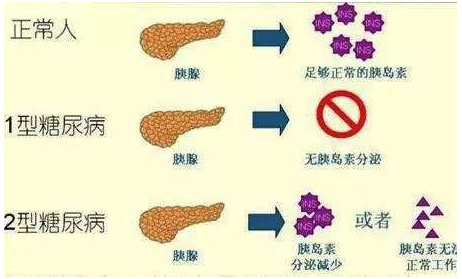 胰岛素抵抗