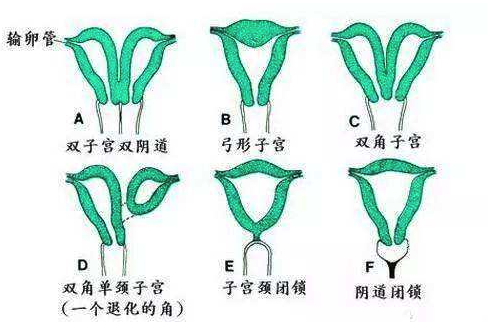 子宫畸形是什么