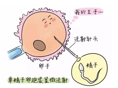 什么是第二代试管婴儿