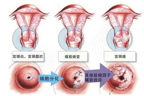 宫颈糜烂的症状有哪些