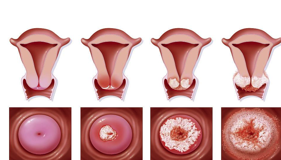 宫颈糜烂的饮食调理