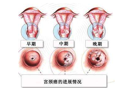 宫颈糜烂是什么意思