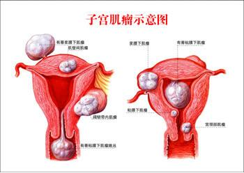 子宫肌瘤症状