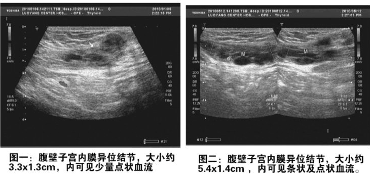 子宫内膜异位症怎么检查