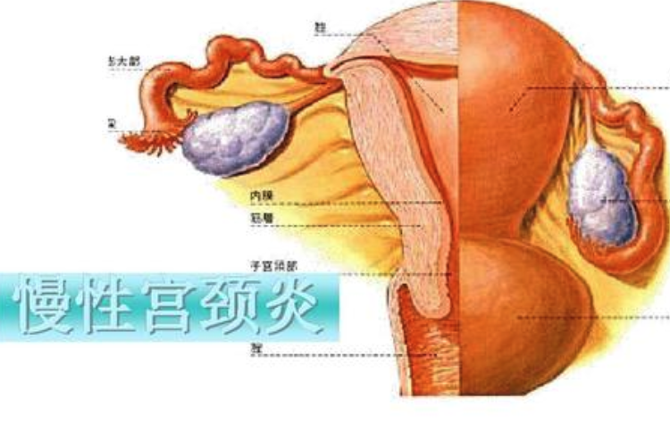 宫颈炎症状有哪些