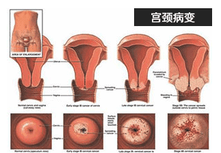 宫颈炎怎么诊断