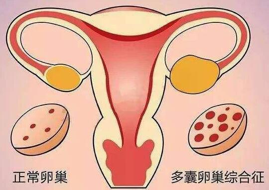 多囊卵巢综合症治疗方法有哪些