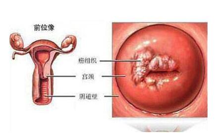 宫颈炎是什么意思