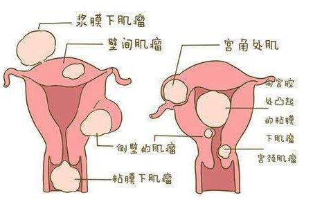 子宫肌瘤是什么，有何症状