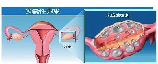 多囊卵巢综合症诊断方法有哪些