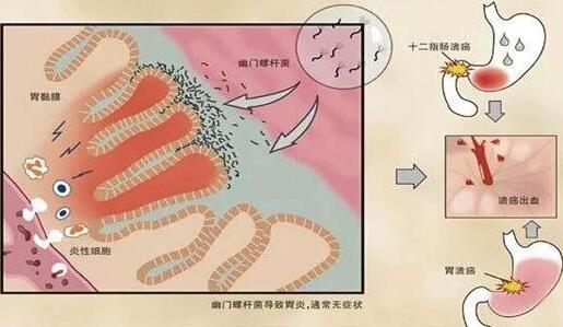 盆腔积液饮食要注意什么