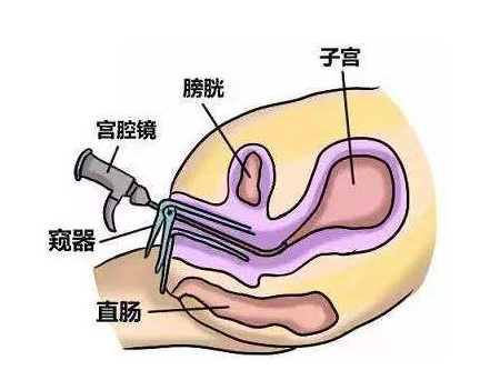 宫腔镜检查