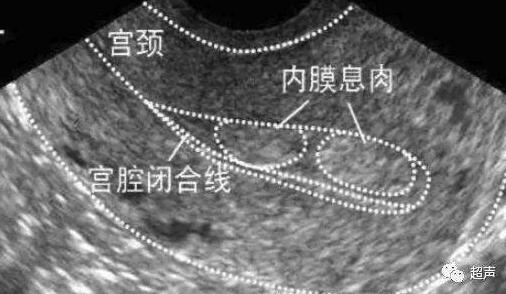 子宫内膜息肉有哪些症状