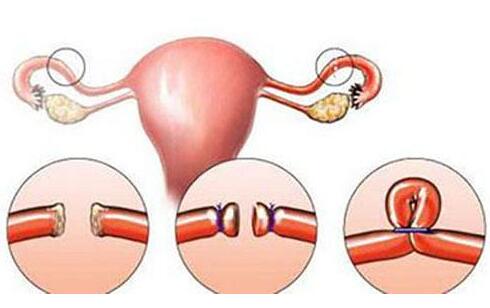 输卵管堵塞的原因有哪些