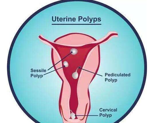 子宫内膜息肉如何预防