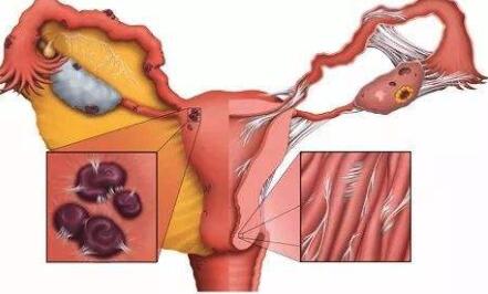 宫腔分离是什么病症