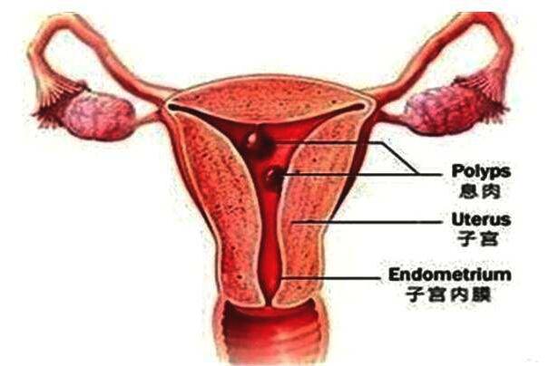 子宫内膜息肉是什么病症