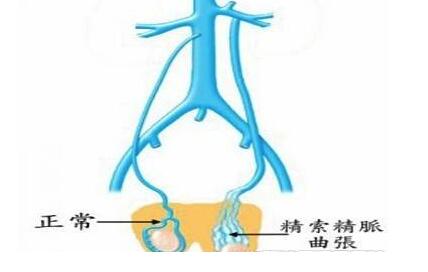精索静脉曲张怎么预防