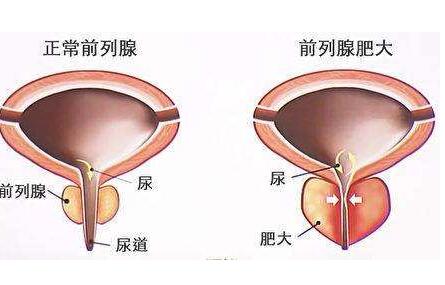 前列腺增生的症状有哪些