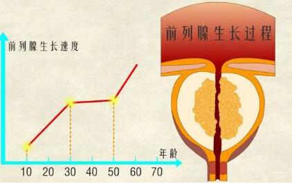 前列腺增生怎么治疗好