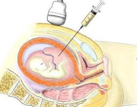羊水穿刺有哪些风险
