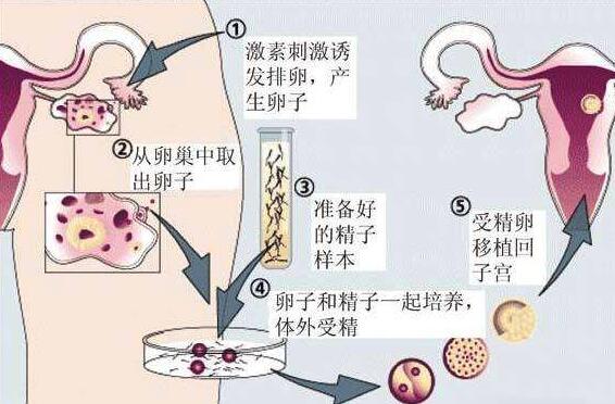 第一代试管婴儿要多长时间