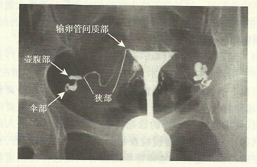 输卵管造影的危害是什么