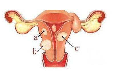 子宫肌瘤能做微创手术吗