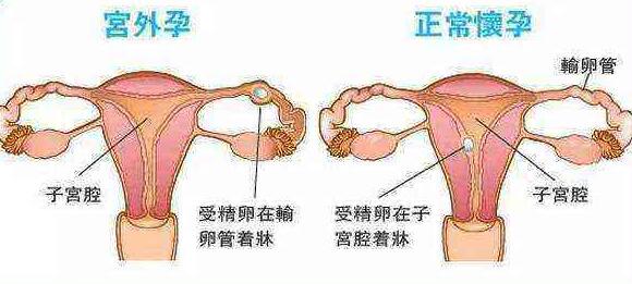 输卵管堵塞会造成宫外孕吗