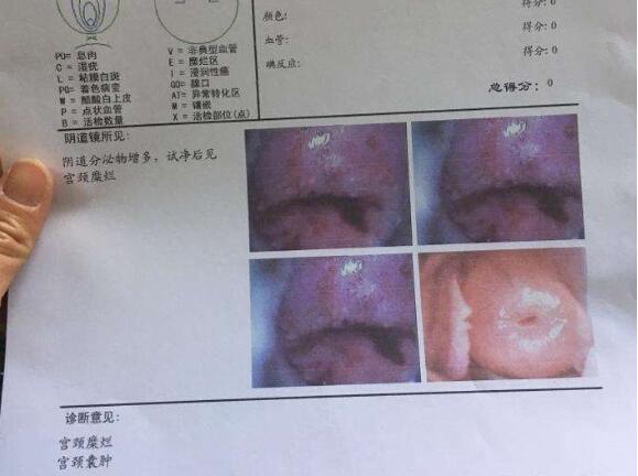 宫颈糜烂检查多少钱