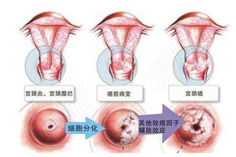 宫颈糜烂有几度