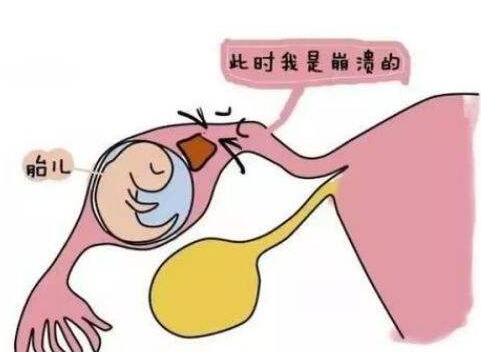 输卵管妊娠会出血吗