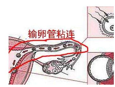 输卵管粘连怎么治疗