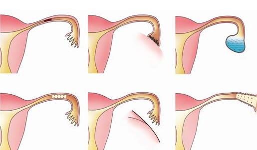 输卵管积水有哪些症状