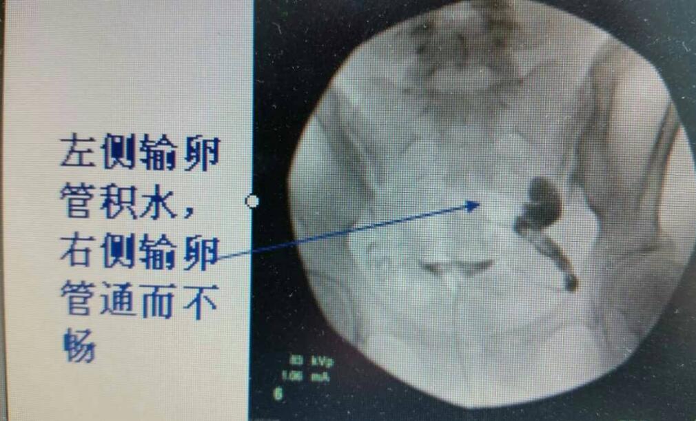 输卵管积水有哪些症状