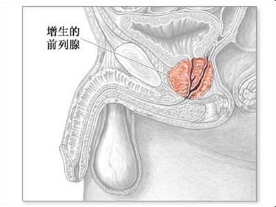 前列腺增生会尿血吗