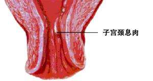 子宫内膜息肉能同房吗