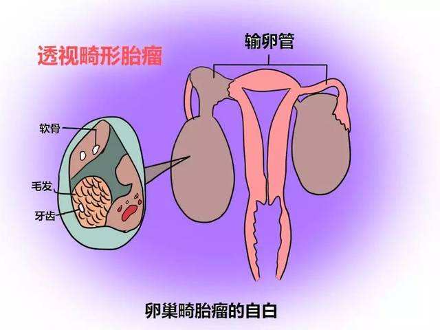 卵巢畸胎瘤是什么病