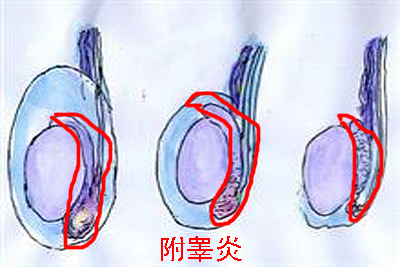 如何预防附睾炎