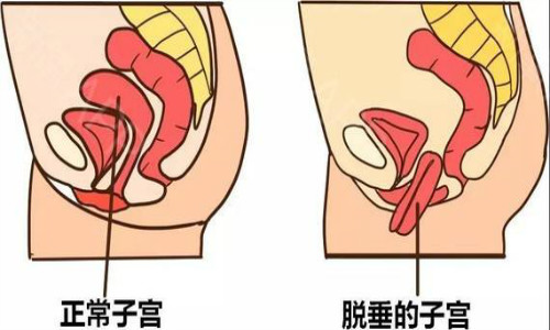 阴壁膨出会有什么影响