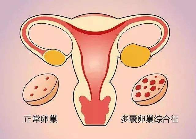 多囊卵巢综合症怎么办