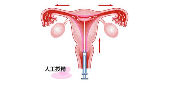 人工授精一般能做几次