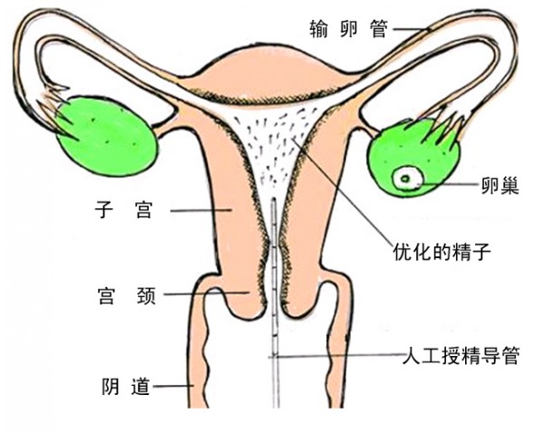 人工授精是把精子注入到哪个部位