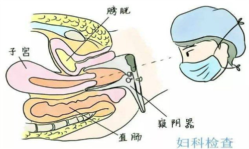 宫颈腺囊肿的检查方法