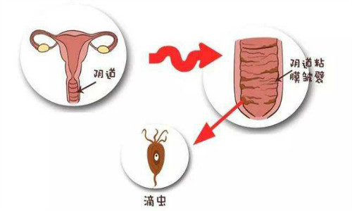 滴虫感染怎么治疗